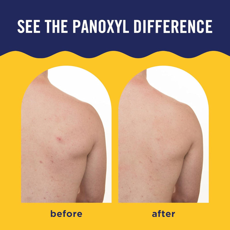 Boefore and after images of a persons back showing the acne reducing effects of PanOxyl Acne Banishing Body Spray
