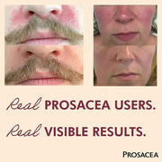 Prosacea Medicated Gel, Heals Rosacea Symptoms 0.75 oz