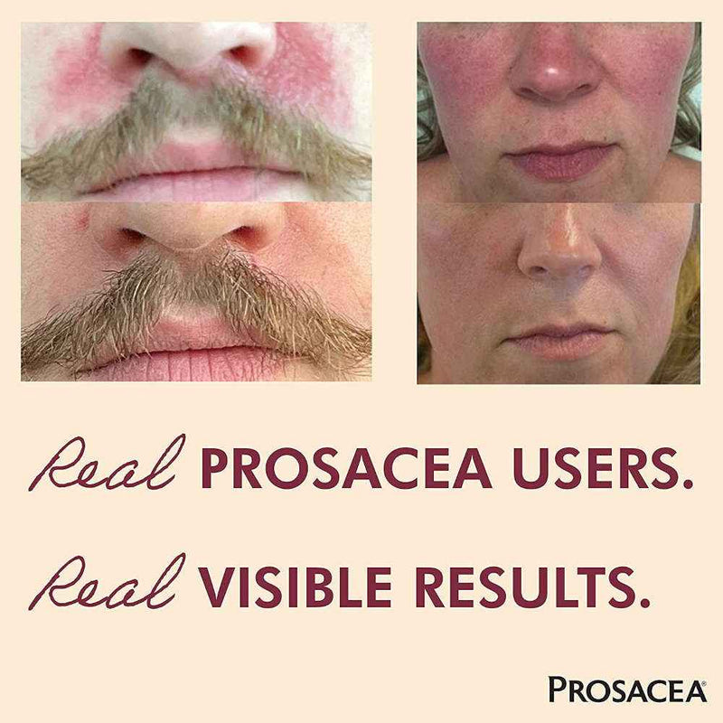 Prosacea Medicated Gel, Heals Rosacea Symptoms 0.75 oz