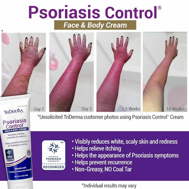 Triderma Psoriasis Control Face & Body Cream 4.2 Oz Banner Showing Psoriasis kin Sufferers 