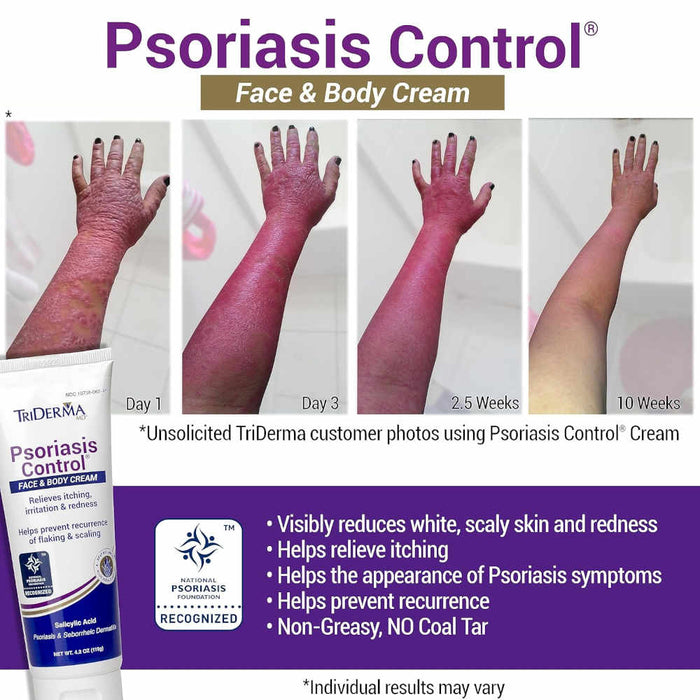 Triderma Psoriasis Control Face & Body Cream 4.2 Oz Banner Showing Psoriasis kin Sufferers 