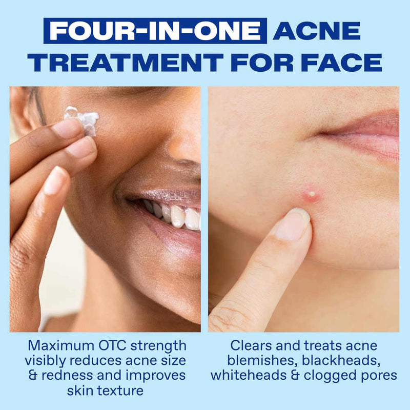 Advertisement for Differin Acne Spot four-in-one facial acne treatment, showing cream being applied and a finger touching a blemish; claims it reduces acne and clears clogged pores.