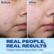 Before-and-after cheek photos show visibly reduced acne after one day of Differin Acne Spot Treatment use, highlighted by dashed circles; blue text says “Real people, real results,” with a small results-may-vary disclaimer.