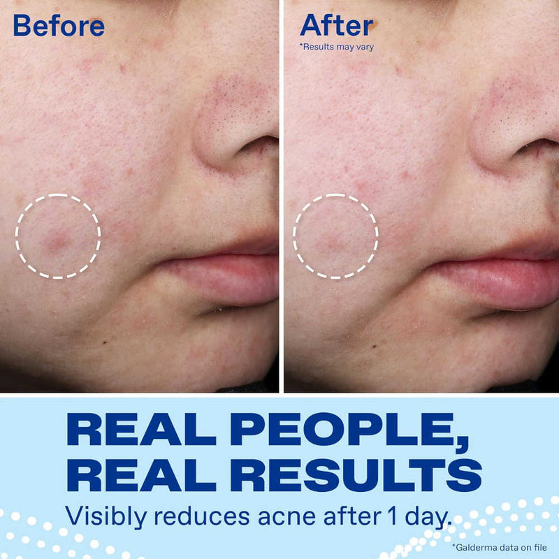 Before-and-after cheek photos show visibly reduced acne after one day of Differin Acne Spot Treatment use, highlighted by dashed circles; blue text says “Real people, real results,” with a small results-may-vary disclaimer.