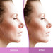 differin repair resurfacing Scar Gel 1 Oz Banner Showing Before And After Pictures On Female Face