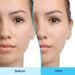 Differin Gel Adapalene Acne Treatment 15g Banner Showing Before And After Pictures On Human Face After Product Use