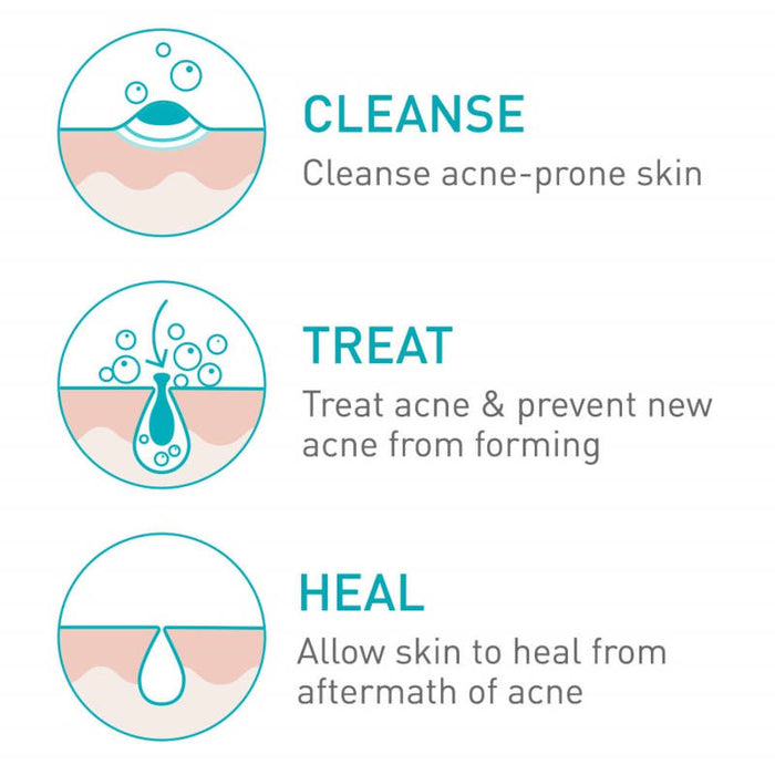 CeraVe Acne Foaming Cleanser 5 Oz banner showing product treatment stages
