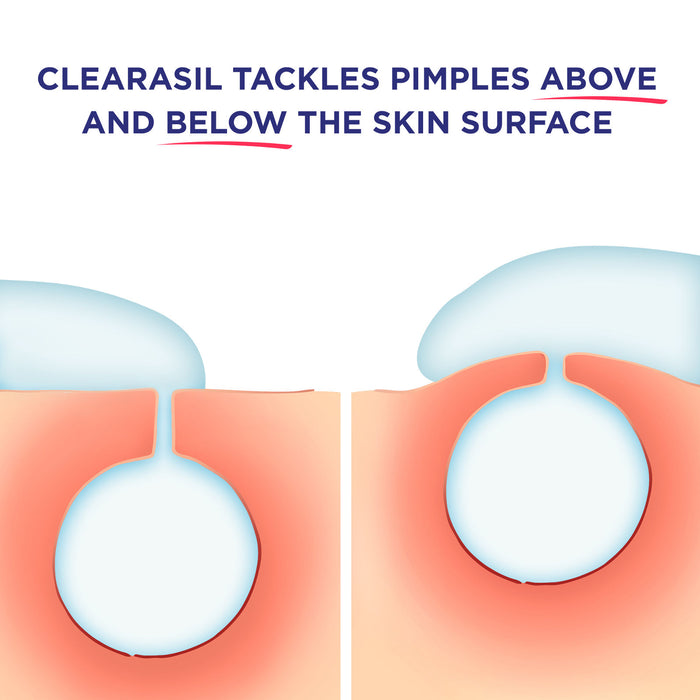 Banner showning how Clearasil Stubborn Acne Control 5in1 Spot Treatment Cream works above and below the skins surface